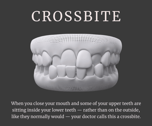 crossbite