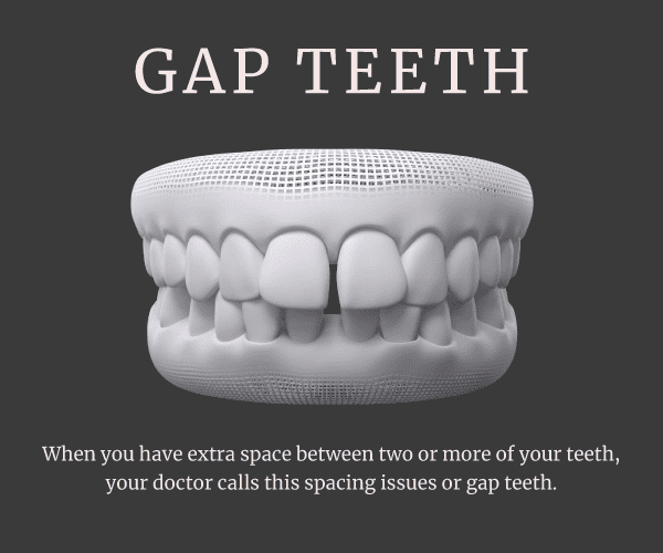 gap-teeth