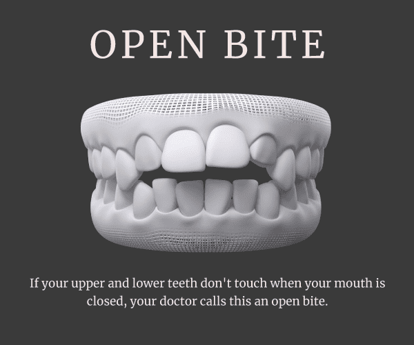 openbite