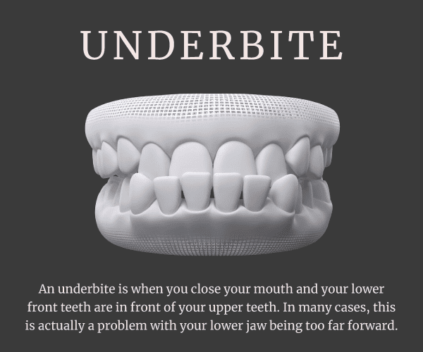underbite