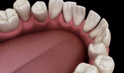 1580104109399crowded-teeth2