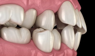 Misaligned-teeth-or-malocclusion-3d-render-1024x733