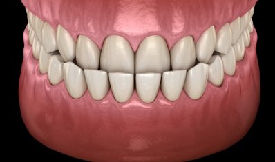 Underbite-Explanation