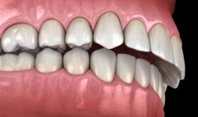 Why-do-Overbites-Occur-e1660842156389